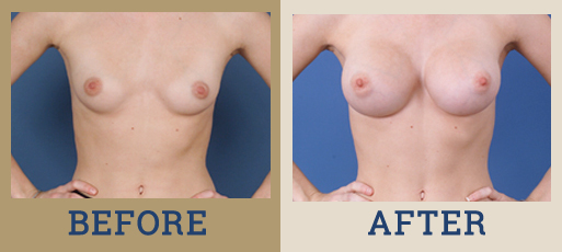 Breast Augmentation