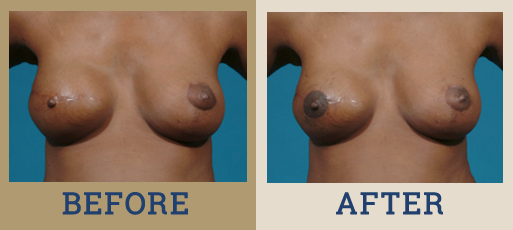 Breast Reconstruction