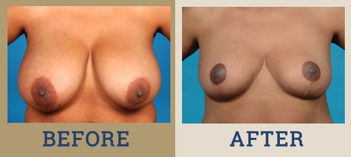 Breast Reduction