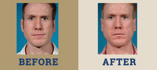 drha_beforeafter_chin_implant_1-1