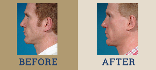 drha_beforeafter_chin_implant_1-2