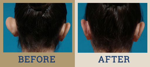 drha_beforeafter_ear_pinning_1-2