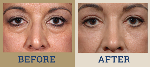 Eyelid Surgery