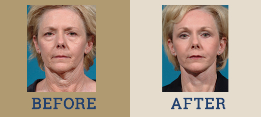 Facelift / Necklift