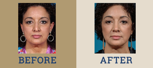 drha_beforeafter_facelift2