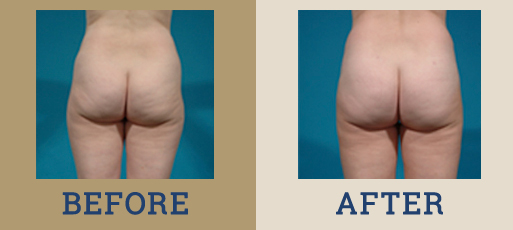 Liposuction & Body Contouring