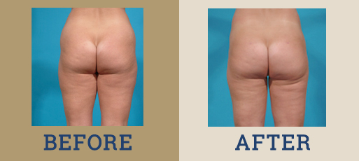 Liposuction Surgery in Dallas & Plano, TX