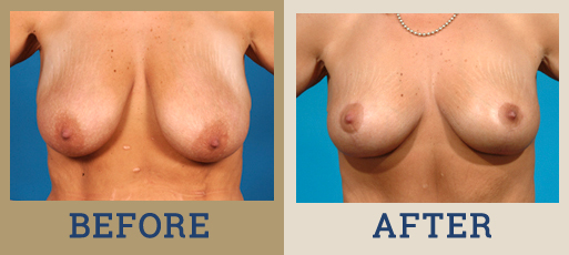 Breast Lift (Mastopexy)