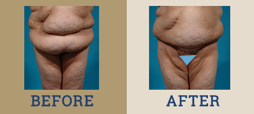 Panniculectomy