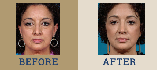 Nasal Reshaping (Rhinoplasty)