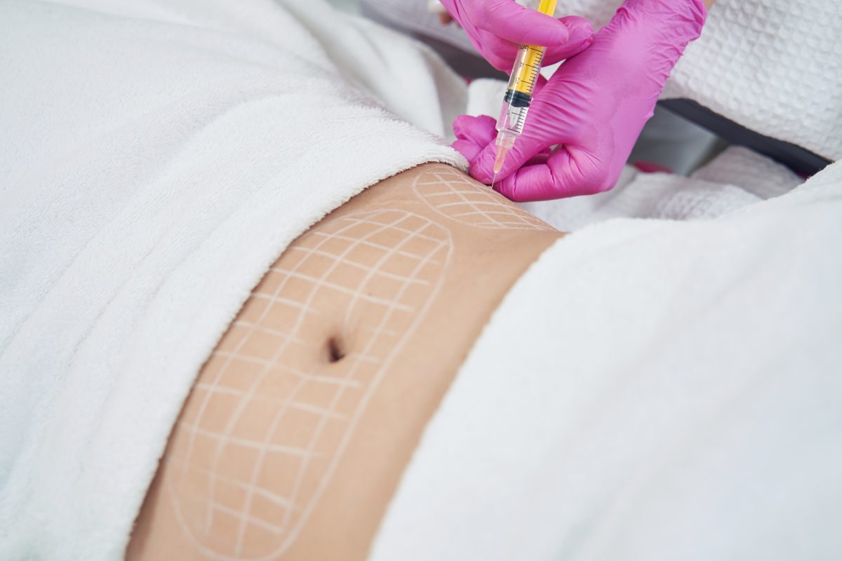 Tummy Tuck Recovery Process: A Comprehensive Guide to Healing and Results